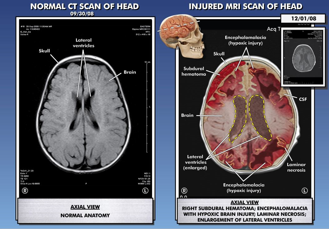 CT Scan of Head