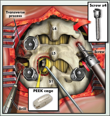 Transverse Process